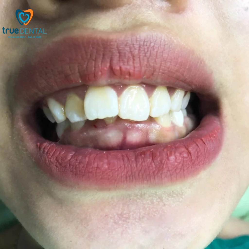 Khớp cắn sâu điều trị bằng cách nào để răng đều và bền? 1 Bác sĩ Đỗ Thái Vĩnh Lai giải đáp khớp cắn sâu điều trị bằng cách nào