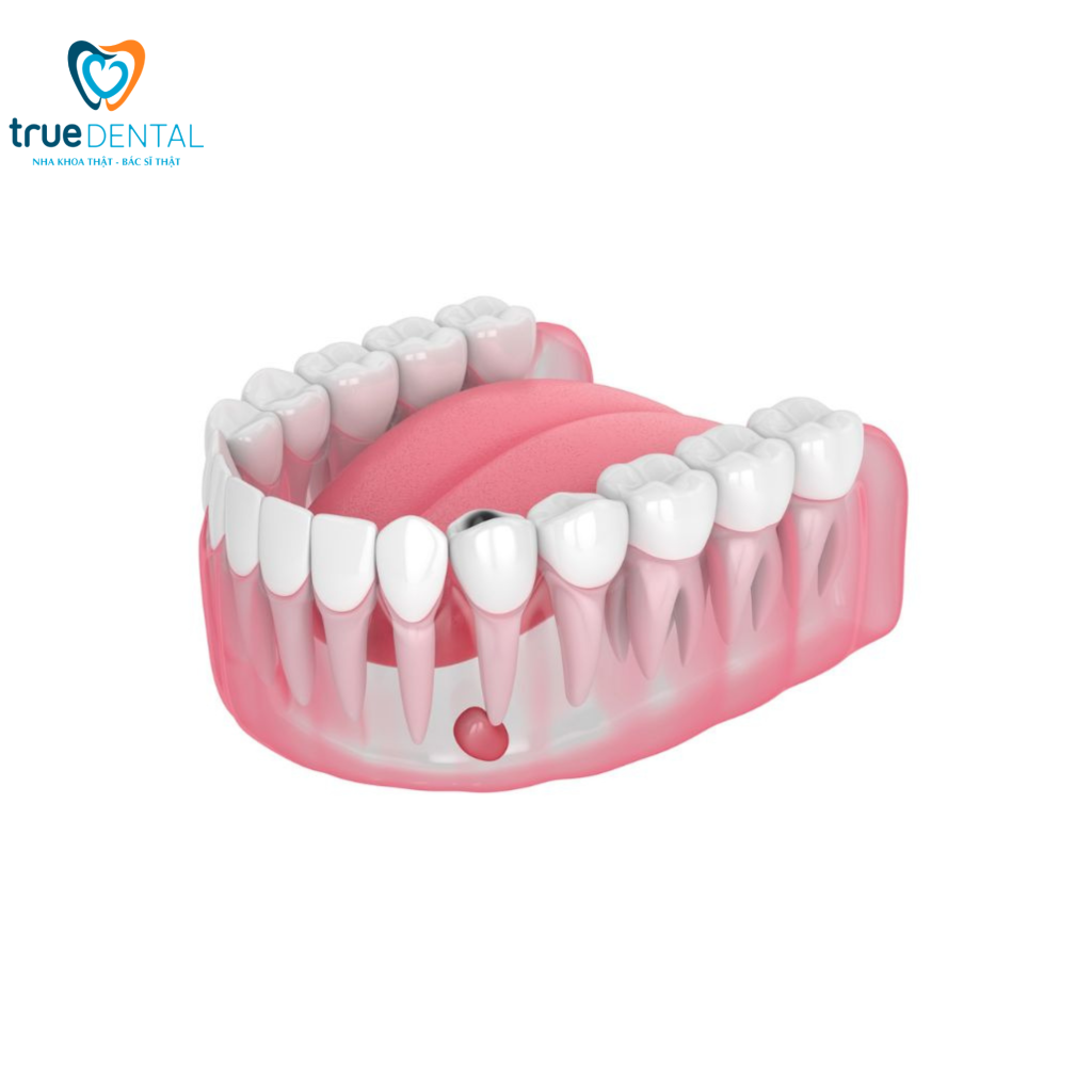 Viêm chân răng khác viêm nha chu thế nào và cách nhận biết? 1 Bác sĩ Đỗ Thái Vĩnh Lai giải đáp viêm chân răng khác viêm nha chu thế nào