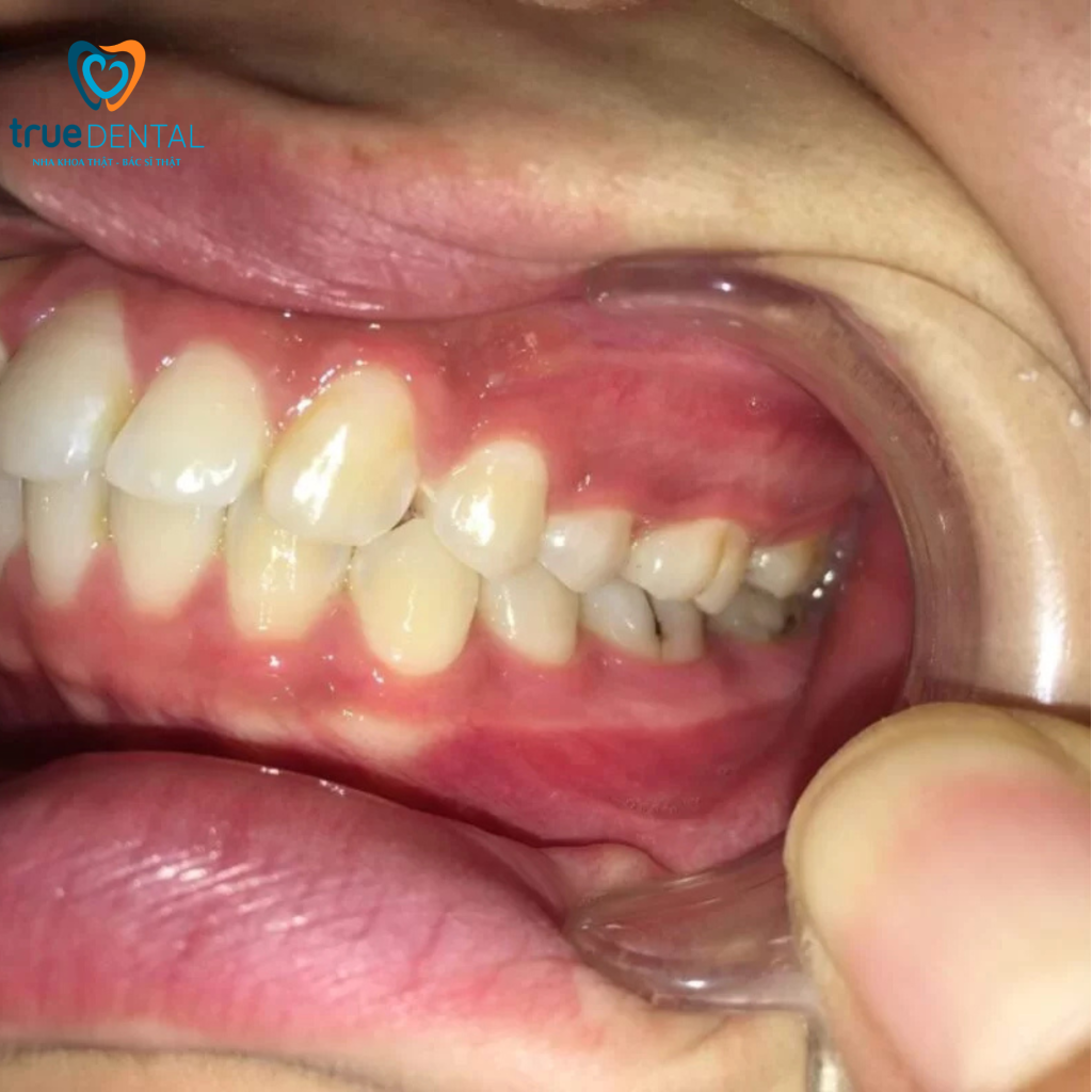 Khớp cắn sâu điều trị bằng cách nào để răng đều và bền? 2 Bằng chứng khoa học về điều trị khớp cắn sâu