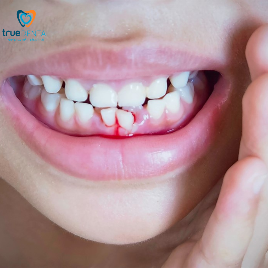 Viêm chân răng khác viêm nha chu thế nào và cách nhận biết? 3 Làm sao biết mình bị bệnh nào