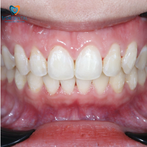khớp cắn đối đầu có cần điều trị không