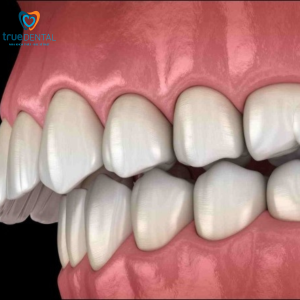 khớp cắn sâu điều trị bằng cách nào