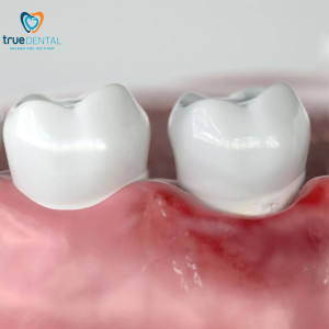 viêm chân răng khác viêm nha chu thế nào